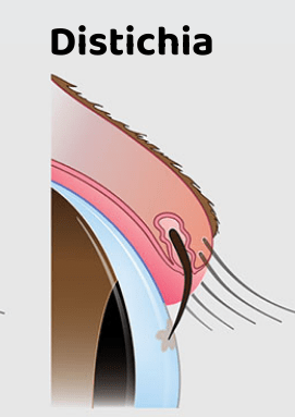 Distichiasis